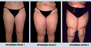 Patient with stage 2 lipedema (A), showing a slight improvement and